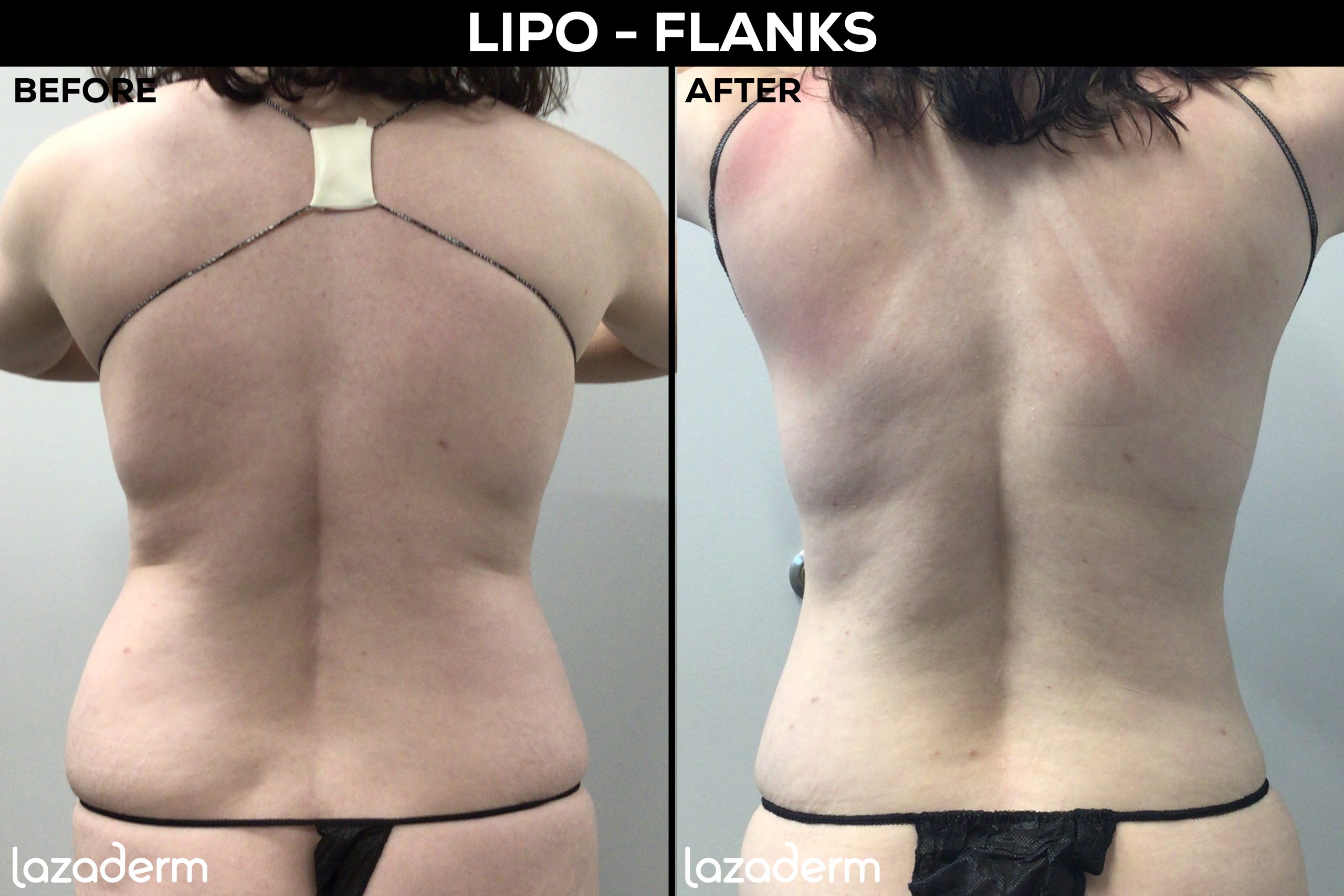 Lipo 360° Abdomen, Hips, Waist, Back, Immediate Results, Awake Tumescent  Liposuction