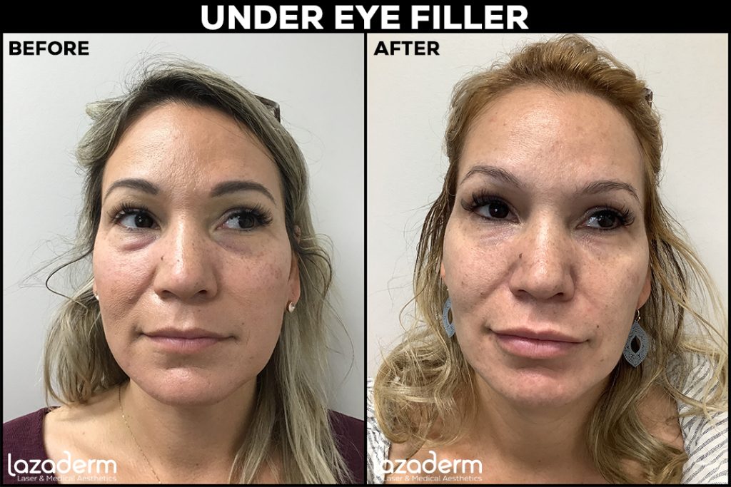 Under Eye Filler Results