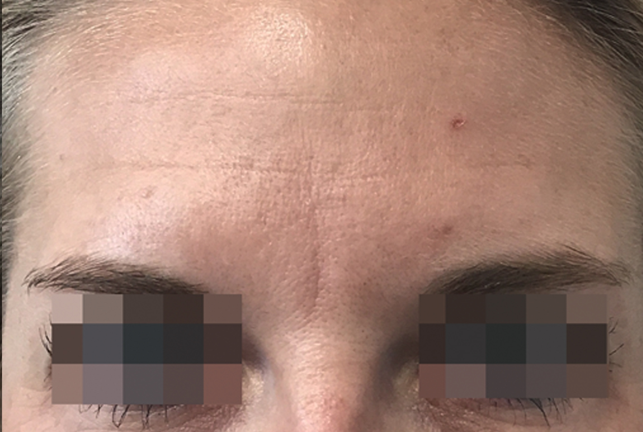 botox on forehead after