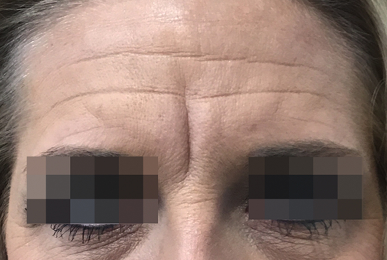 botox before on forehead