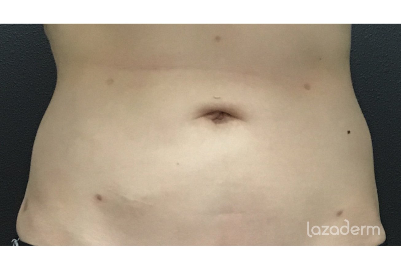 lipo after