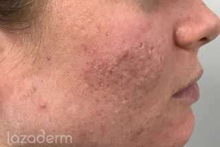 microneedling_with_radiofrequency
