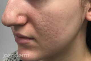 microneedling_with_radiofrequency