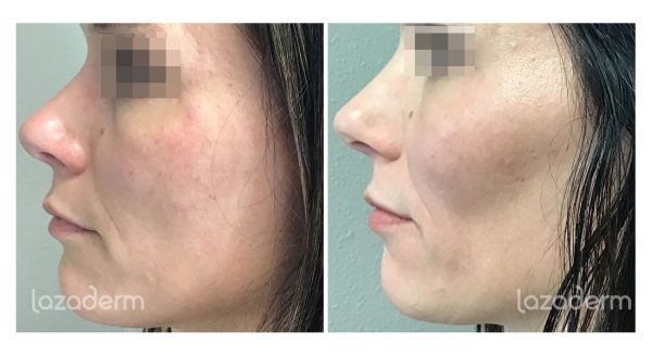 Cheek Filler Before and After - Lazaderm