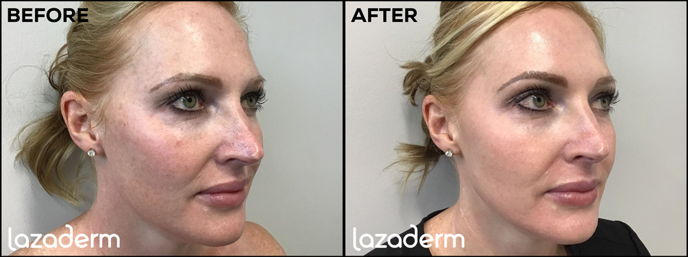 MOXI Laser Before and After