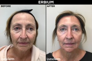 erbium uses