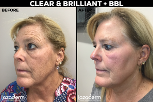 Clear + Brilliant BBL Before and After