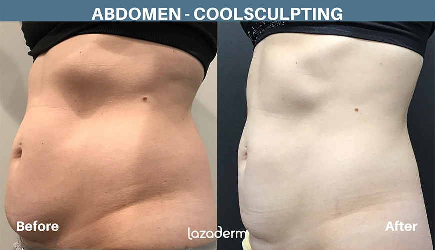Before and after comparison of a person's abdomen showing the results of a CoolSculpting treatment. The "before" image on the left features visible fat bulges, while the "after" image on the right shows a noticeably smoother and slimmer abdomen.