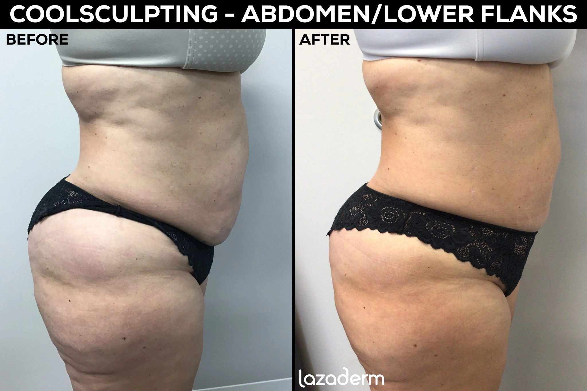 Before and after images of the CoolSculpting® procedure on the abdomen and lower flanks