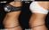Before and after results of CoolSculpting® on the abdomen