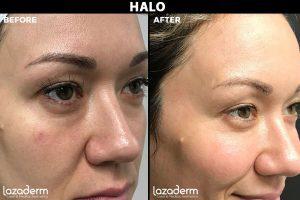 Before and after comparison of a woman's face showing improvements in skin texture and reduced dark circles under her eyes, with labels "BEFORE" and "AFTER" on each respective image.
