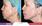 Side-by-side images of a woman's profile before and immediately after a Y Lift cosmetic procedure, showing marked improvements in facial contours and skin tightness.